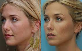 Definitive guide on cheek augmentation with fillers, including the procedure overview, benefits, risks, recovery, before & after photos, costs, and more. Svetlana Vasic Appleceki Profile Pinterest