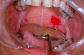 Image result for Mouth ulcers symptoms roof of the mouth