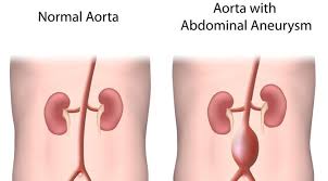 Aneurisma adalah pelebaran abnormal pada pembuluh nadi karena kondisi dinding pembuluh darah yang lemah. Penyakit Aneurisma Aorta Abdominalis Gejala Penyebab Pengobatan Klikdokter Com
