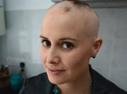 Alopesi Sac Dokulmesi Nedir Belirtileri Nedenleri Ve Tedavisi Sac Dokulmesi Sac Ve Sac Bakimi