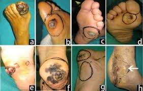 It is usually painless, but an advanced tumour invading underlying bone may cause. Acral Melanoma Am Happened On Foot A Melanoma With An Ulcer Download Scientific Diagram