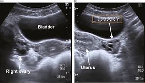 Check spelling or type a new query. Ultrasound Of Pelvic Anatomy Scanning Techniques And Normal Findings Chapter 4 Ultrasound In Reproductive Healthcare Practice