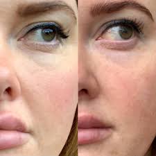 Skin texture refers to the condition of your skin's surface. Microneedling Caryl Baker Visage