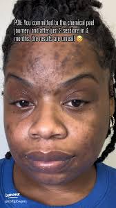 Effective Ways Chemical Peels Reduce Acne Scars: Tips & Real Experiences