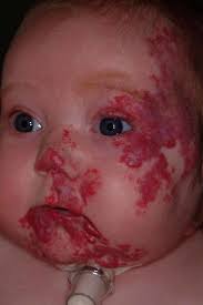 A prospective study of PHACE syndrome in infantile hemangiomas: Demographic  features, clinical findings, and complications