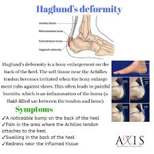 Insertional achilles tendinopathy retrocalcaneal bursitis haglund deformity (i.e. Haglund S Deformity Axis Physiotherapy Fitness Studio Facebook