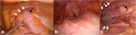 If the cancer was part of a polyp and the polyp is completely removed during a colonoscopy, no further surgery may be needed. A Rare Case Of Ascending Colon Adenocarcinoma Incarcerated In An Inguinoscrotal Hernia Case Report And Literature Review Surgical Case Reports Full Text