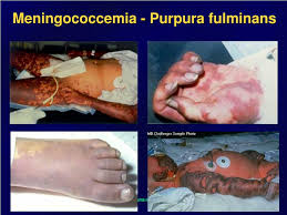 Purpura fulminans due to staphylococcus aureus. Ppt Meningitis And Encephalitis Powerpoint Presentation Free Download Id 4544293