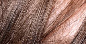 Find your next look without going to the salon. Identify Head Lice Photos And Examples Head Lice Specialist