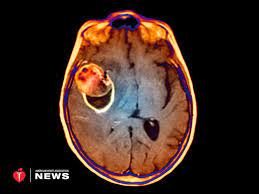 Can Statins Help Prevent Brain Aneurysms From Rupturing?