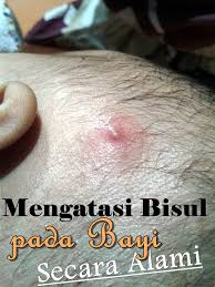 Bisul dapat muncul di bagian tubuh mana saja termasuk pada bagian kepala yang sangat mengganggu saat tidur atau beraktivitas karena rasa sakit yang di timbulkannya. Diyanika Journal Mengatasi Bisulan Pada Bayi Secara Alami