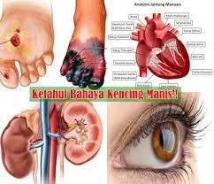 13 punca utama anda boleh dapat kencing manis 1. 4 Kesan Dan Masalah Timpa Kencing Manis Main Center 2 0 Facebook