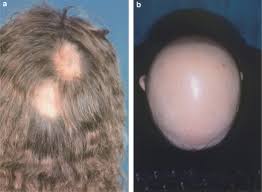 Focal hair loss can be further broken down into scarring and nonscarring. Autoimmunity Alopecia Areata Sciencedirect