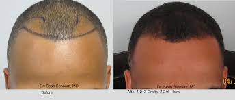 Fue hair transplant is a procedure of redistribution of scalp hair. Men S African American Hair Transplant Dr Sean Behnam