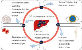 Image result for Copper Poisoning