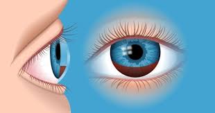 Image result for Hyphema