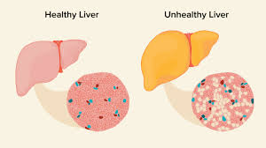 fatty liver causes symptoms and diagnosis