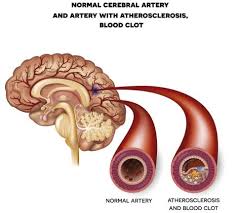 As a result, blood cells may break and leak blood into. Acv Isquemico O Infarto Cerebral Sintomas Bupa