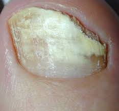 Image result for mykoza nehtů