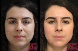 A dermatologist will be able to evaluate your skin's needs and prescribe a suitable course of treatment. Acne Scar Treatment Before After Photos Pictures Patients