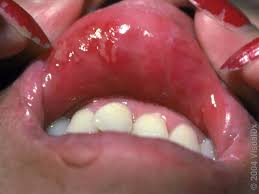 Image result for Canker sores symptoms roof of the mouth