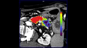512 x 413 png 200 кб. Ct Volume Perfusion Imaging In A Case Of Suspected Pancreatic Cancer Siemens Healthineers Belgium