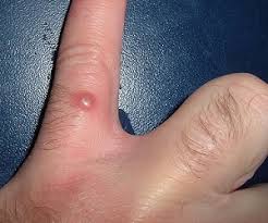 They could be ingrown hairs. 7 Types Of Bumps And Blemishes