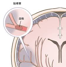 Look up in linguee suggest as a translation of 脳梗塞 è³æ¢å¡ã®çç¶ãåå  ç¥æ¸å¸åæ°´åºã®ç¥æ¸è³ããã¯