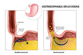 Image result for Pediatric Reflux