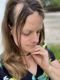 Pludselig tabte Helene alt håret