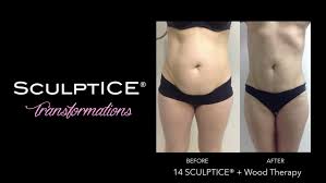 Browse through the before and after airsculpt® transformations that interest you. Body Contouring Faq Hidden Gem Luxury