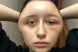 Vor allem dann, wenn du selbst im heimischen bad experimentierst und nicht so recht weißt, was du gerade eigentlich tust. Allergie Schock Nach Haarefarben Studentin Fast Gestorben Gala De