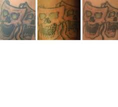 Check spelling or type a new query. The Laser Tattoo Removal Healing Process