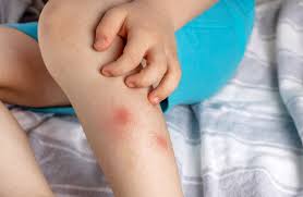 Image result for mosquito bite