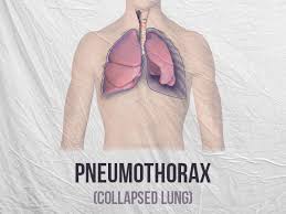 A small pneumothorax may cause few or no symptoms. Pneumothorax Collapsed Lung Types Causes Symptoms Risk Factors And Treatments Boldsky Com