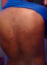 If you can, i think it would be ideal to go to a dermatologist and see what they say. Acne Backside Acne Scars How Do I Get Rid Of These Skincareaddiction