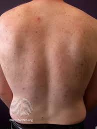 Image result for Keratosis pilaris