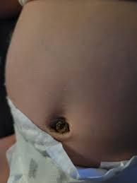 Once the stump falls off, you can give your baby a proper bath. Belly Button After Umbilical Cord Falls Off May 2021 Babies Forums What To Expect