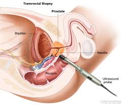 Germline mutations and prostate cancer. Prostate Cancer Treatment Pdq Patient Version National Cancer Institute
