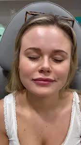 Botox Injection Techniques for Effective Results