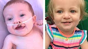 Surgery is usually scheduled during the third month of life. Cleft Lip And Cleft Palate Repair Sophia S Story Children S Hospital Of Philadelphia
