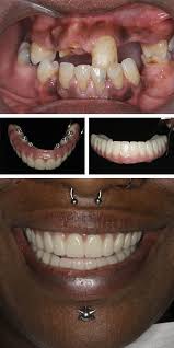 Tooth loss is common and can occur due to trauma or disease. Full Mouth Dental Implants All On 6 Dental Implants Implant Dentist Nyc