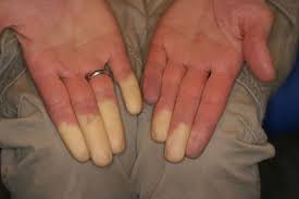 Es kann aber sowohl prädiktor als auch symptom bei zugrunde liegenden erkrankungen unterschiedlichster pathogenese sein. Raynaud S Phenomenon Doccheck
