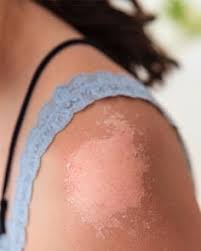 Lotions are typically more effective. 9 Best Sunburn Peeling Ideas Sunburn Peeling Sunburn Peeling Skin