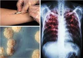 This term refers to not only girls but the male gender also. World Tb Day