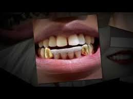 At 20 karats, it's roughly 80%. Gold Teeth Caps Youtube