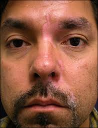 Image result for Vitiligo