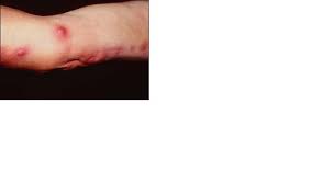 Maybe you would like to learn more about one of these? Mcat Memoranda This Woman Had This Rash After Doing Yard Work I