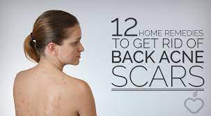 Chemical peels for back acne scars. 12 Home Remedies To Get Rid Of Back Acne Scars
