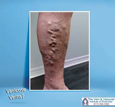 The Board Certified Vascular Surgeons At The Vein And Vascular Institute Of Riverview Recommend That People With Vari Vascular Surgery Veins Treatment Varicose